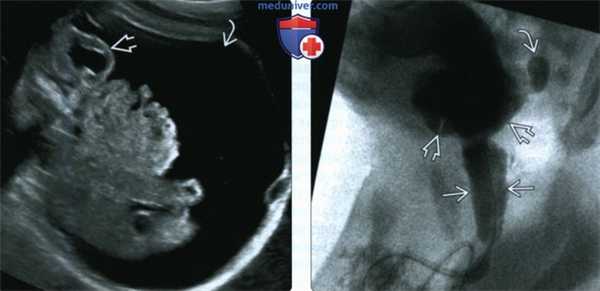 УЗИ, МРТ при клапане задней уретры у плода