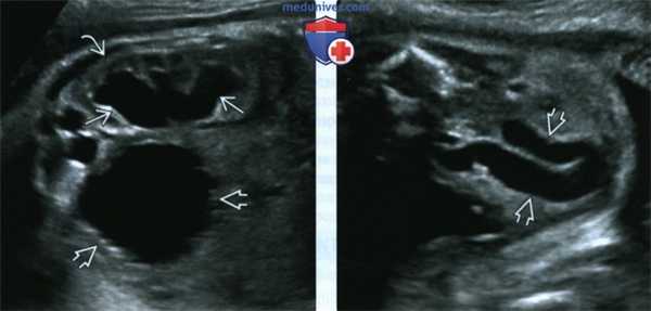 УЗИ, МРТ при клапане задней уретры у плода