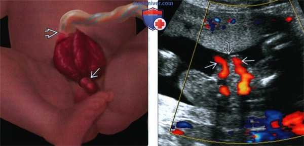 УЗИ, МРТ, рентгенограмма, КТ при экстрофии мочевого пузыря у плода