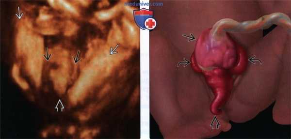 УЗИ, МРТ при клоакальной экстрофии, комплексе OEIS у плода