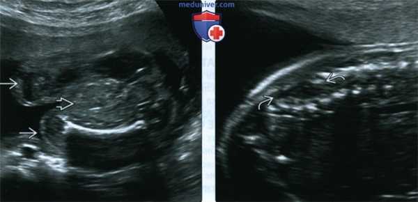 УЗИ, МРТ при клоакальной экстрофии, комплексе OEIS у плода
