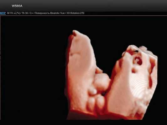 Эхограмма - экстрофия мочевого пузыря в сочетании с отсутствием видимой патологии наружных половых органов (режим 3D)