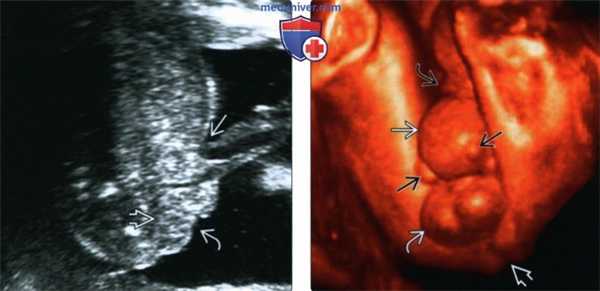 УЗИ, МРТ, рентгенограмма, КТ при экстрофии мочевого пузыря у плода