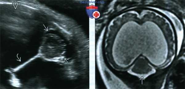 УЗИ, МРТ при ромбэнцефалосинапсисе у плода