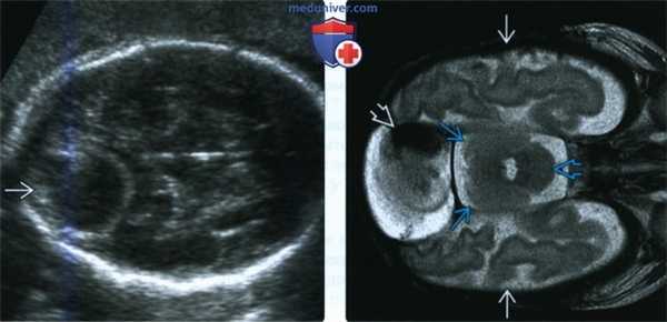 Лучевые признаки мальформации синуса твердой мозговой оболочки плода