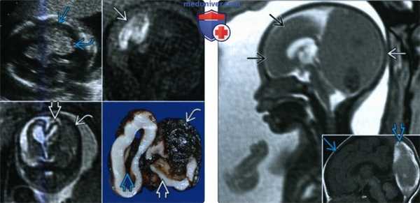 Лучевые признаки мальформации синуса твердой мозговой оболочки плода
