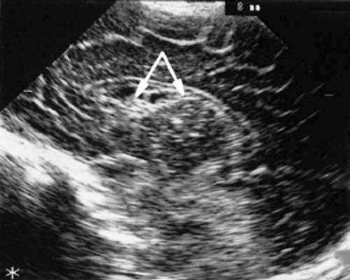 Эхоэнцефалограмма ребенка со смешанной герпес-цитомегаловирусной инфекцией. Правое полушарие