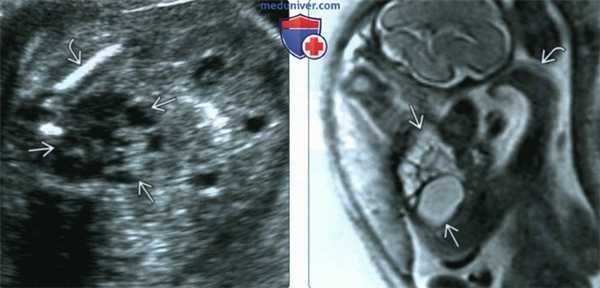 УЗИ, МРТ при мультикистозной дисплазии почки у плода