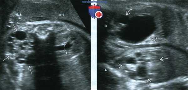 УЗИ, МРТ при мультикистозной дисплазии почки у плода