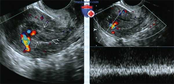 Лучевые признаки неполного опорожнения матки у беременной