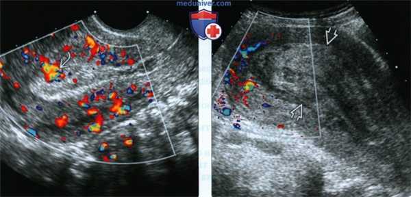 Лучевые признаки неполного опорожнения матки у беременной