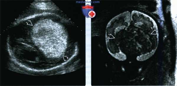 Лучевые признаки опухоли головного мозга у плода