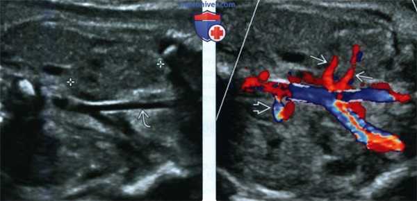 Лучевые признаки эктопии почки у плода