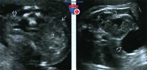 Лучевые признаки эктопии почки у плода