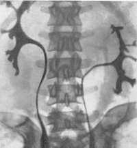 Аномалии развития почек