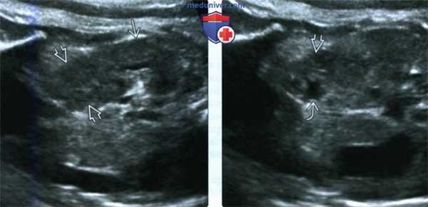 Лучевые признаки перекрестной эктопии почки у плода