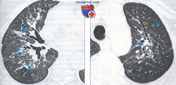 Перибронхиальный интерстициальный фиброз (ПИФ) на КТ легких