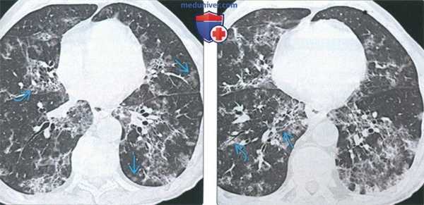Перибронхиальный интерстициальный фиброз (ПИФ) на КТ легких