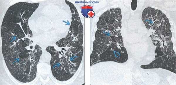 Перибронхиальный интерстициальный фиброз (ПИФ) на КТ легких