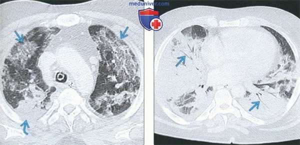 Лучевые признаки острой интерстициальной пневмонии