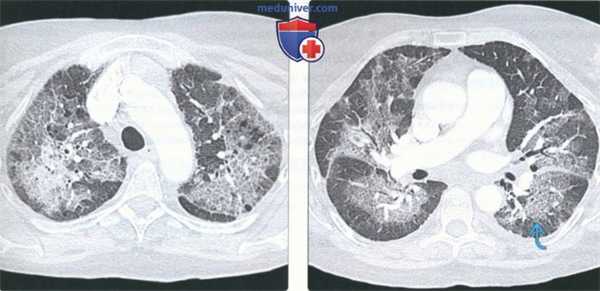 Лучевые признаки острой интерстициальной пневмонии