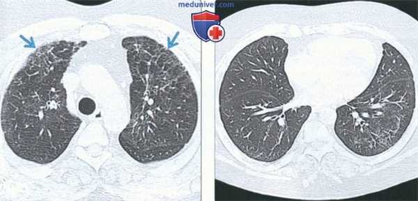 Лучевые признаки острой интерстициальной пневмонии