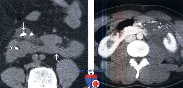 Рентгенограмма, КТ, УЗИ при подковообразной почке
