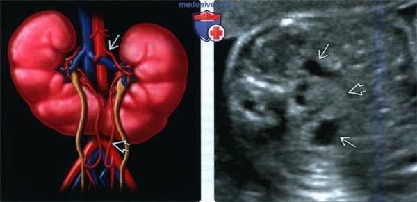 Лучевые признаки подковообразной почки у плода