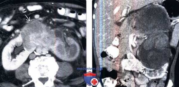 Рентгенограмма, КТ, УЗИ при подковообразной почке
