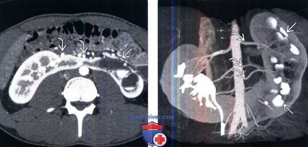 Рентгенограмма, КТ, УЗИ при подковообразной почке