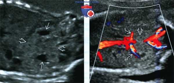 Лучевые признаки подковообразной почки у плода