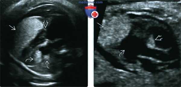 УЗИ, ЭхоКГ при рабдомиоме сердца плода