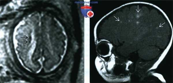 УЗИ, ЭхоКГ при рабдомиоме сердца плода