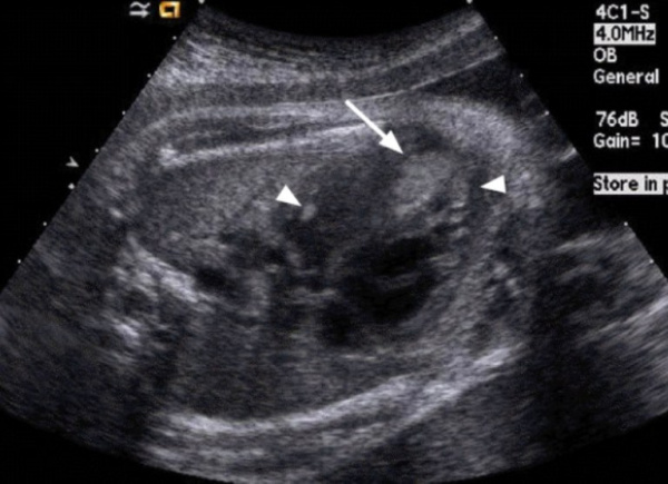 Пренатальное УЗИ. Рабдомиома у 34-недельного плода с туберозным склерозом.