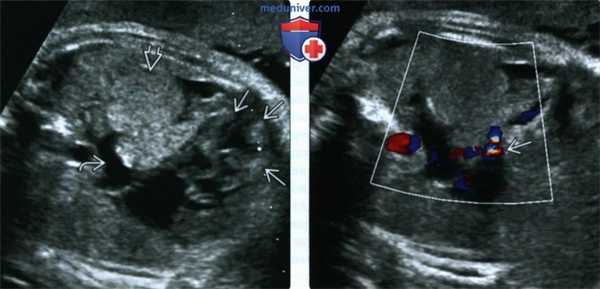 УЗИ, ЭхоКГ при рабдомиоме сердца плода