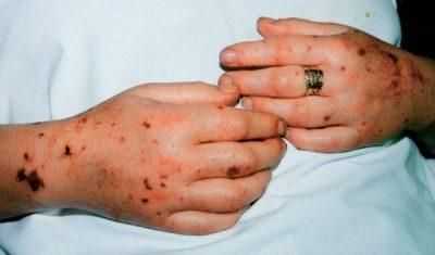 Лучевой сепсис