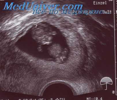 плацента при беременности