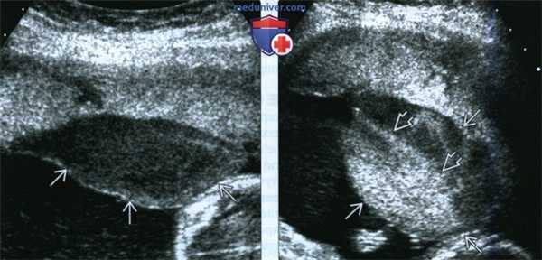 УЗИ, МРТ при расширении и тромбозе межворсинчатого пространства плаценты