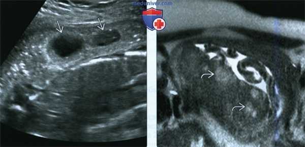 УЗИ, МРТ при расширении и тромбозе межворсинчатого пространства плаценты
