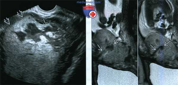 УЗИ, МРТ при расширении и тромбозе межворсинчатого пространства плаценты