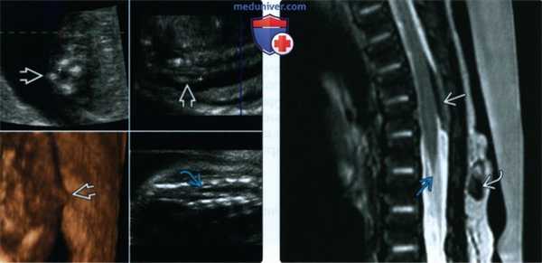Лучевые признаки синдрома фиксированного спинного мозга у плода