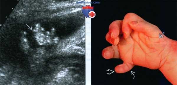 УЗИ при синдроме Смита-Лемли-Опица (ССЛО) у плода