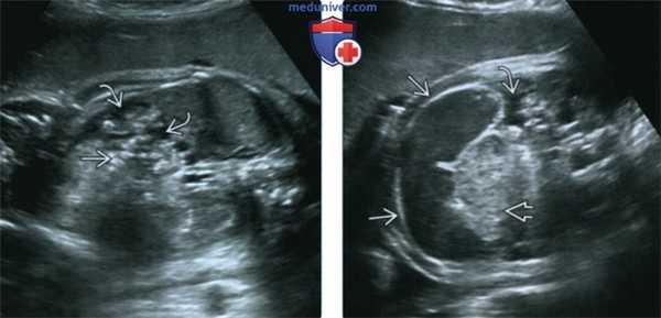 Лучевые признаки муковисцидоза у плода