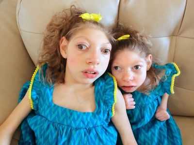 Дети микроцефалы