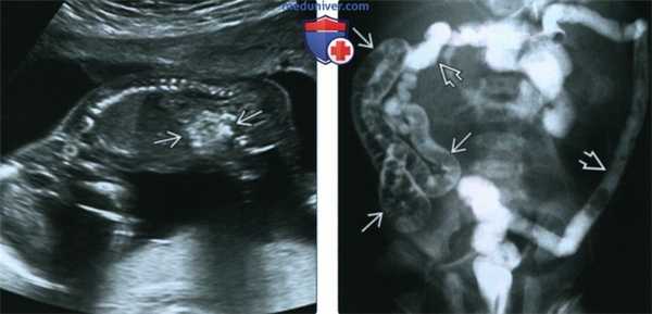 Лучевые признаки муковисцидоза у плода
