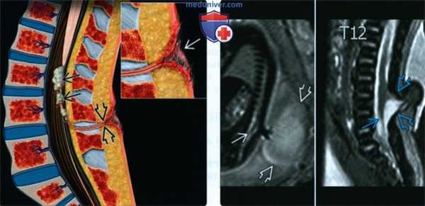 Лучевые признаки синдрома фиксированного спинного мозга у плода