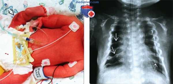 УЗИ, рентгенограмма при несовершенном остеогенезе у плода