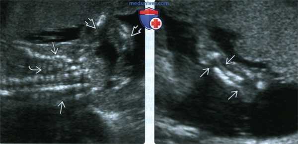 УЗИ, рентгенограмма при несовершенном остеогенезе у плода