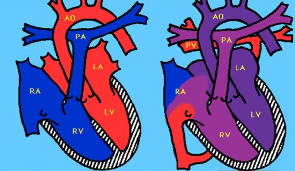 Пороки развития легких