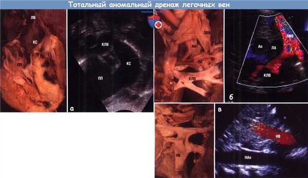 Тотальный аномальный дренаж легочных вен
